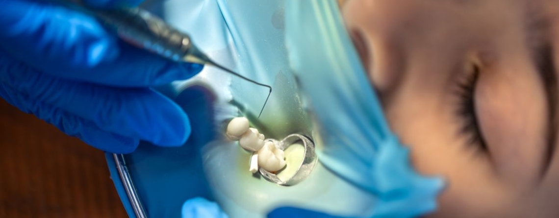 Dentist Placing Dental Tooth Filling