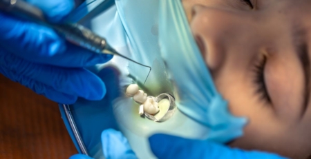 Dentist Placing Dental Tooth Filling