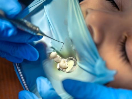 Dentist Placing Dental Tooth Filling