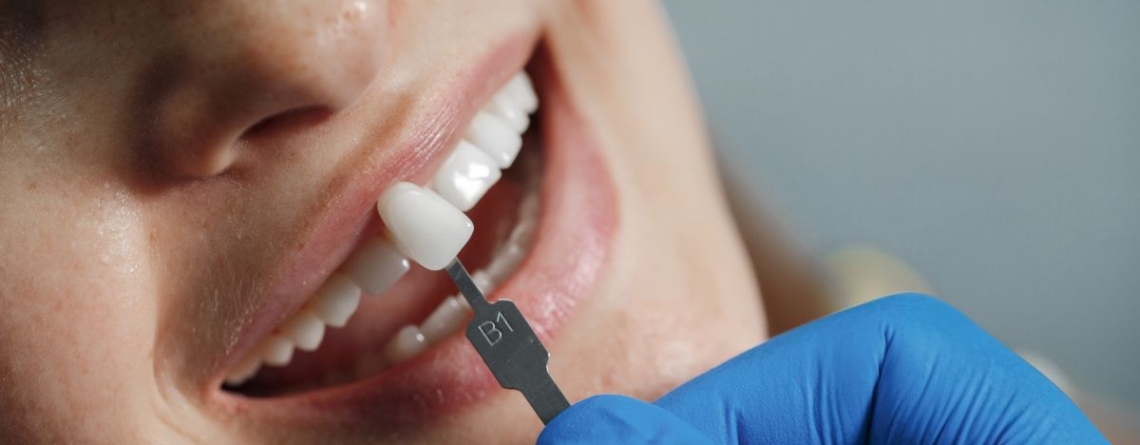 Tooth Repair with Crown Onlay
