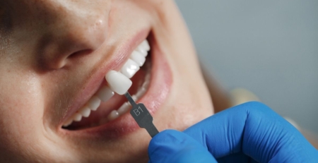 Tooth Repair with Crown Onlay